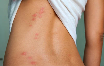 piqure punaise de lit